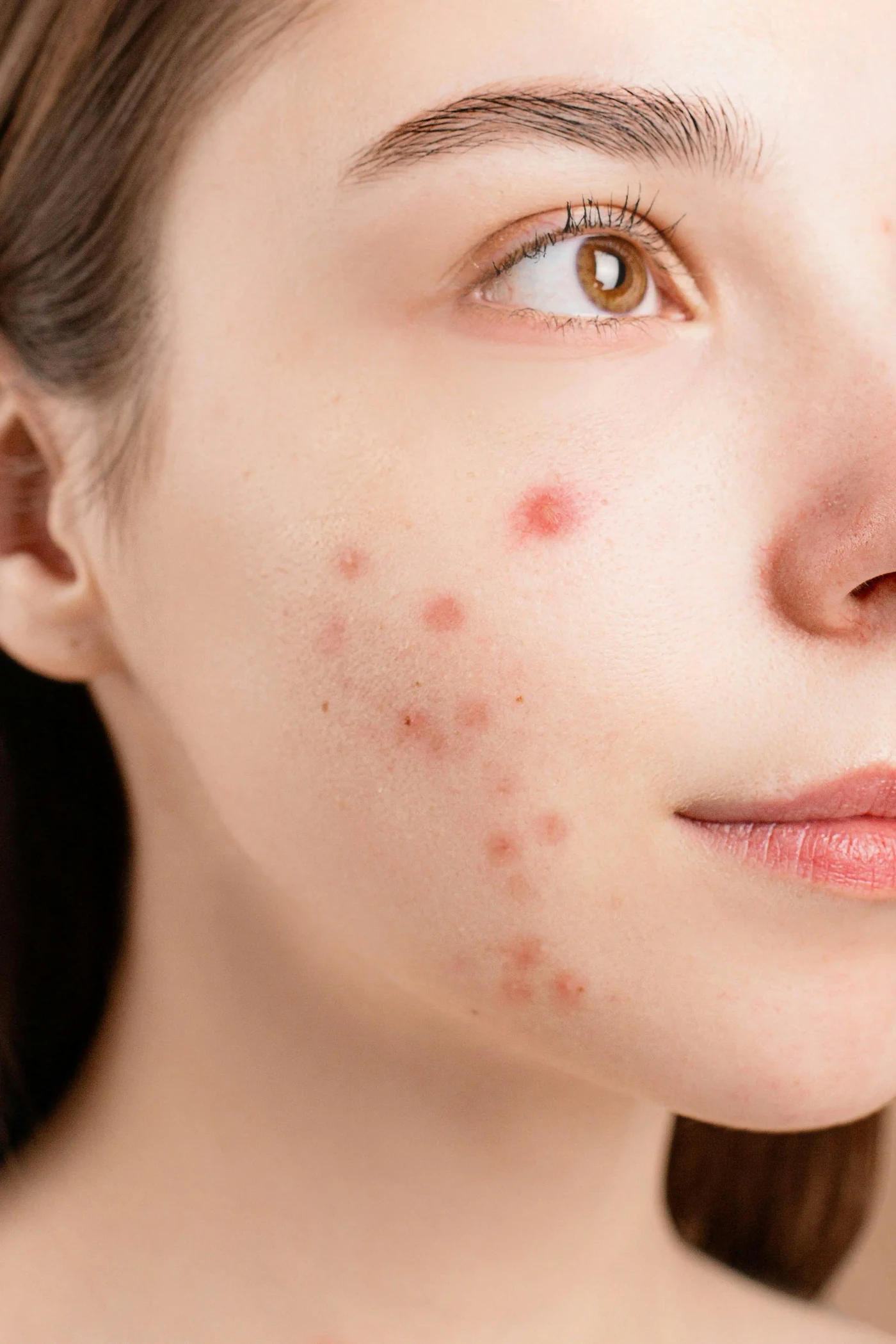 Close-up portrait showing acne-prone skin for specialist acne treatment in Sydney