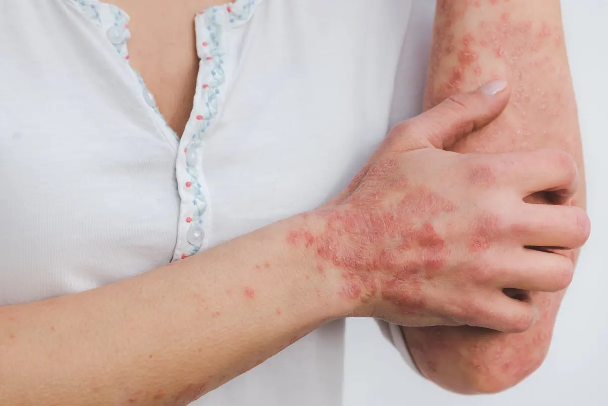Skin detail image representing psoriasis assessment and treatment